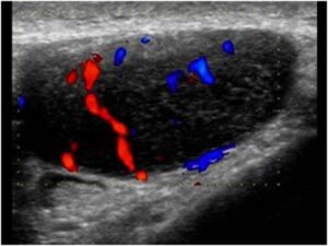 Ultrassonografia de axilas: Parênquima mamário axilar acessório