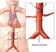 Aorta Normal