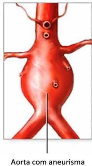 Aorta com aneurisma