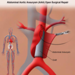 Cirugia Aorta Abdominal