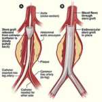 endovascular